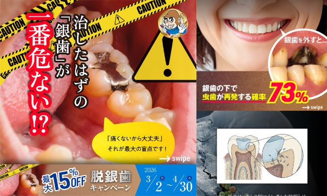 “治したはずの「銀歯」が一番危ない！？⚠️/Instagram更新しました🌈