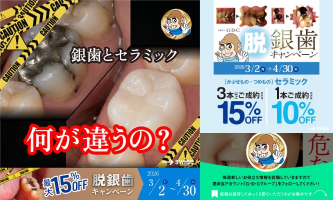 “銀歯とセラミック、何が違うの？🤔✨/Instagram更新しました🌈